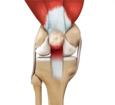 Patellar Tendinitis - 1 - Educational Photo