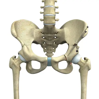 What is Periacetabular Osteotomy - Benjamin Domb MD