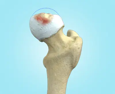 Perthes Disease - Benjamin Domb MD