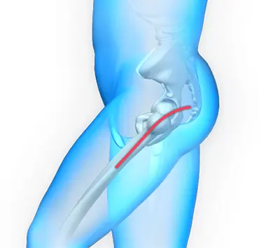 Posterior hip replacement