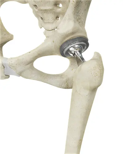 Posterior hip replacement