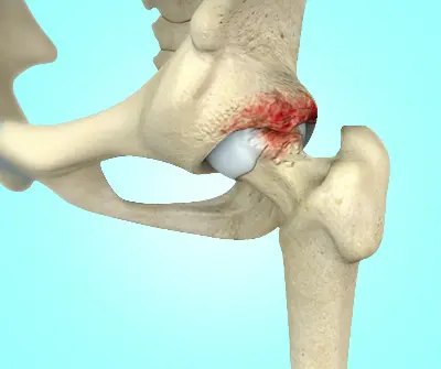 Risk Factors for Sacroiliac Joint Pain - Benjamin Domb MD