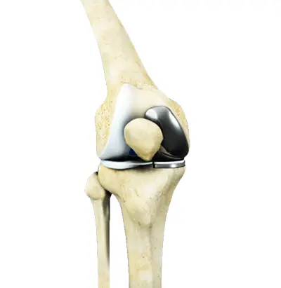 Meniscal Tears - 6 - Educational Photo