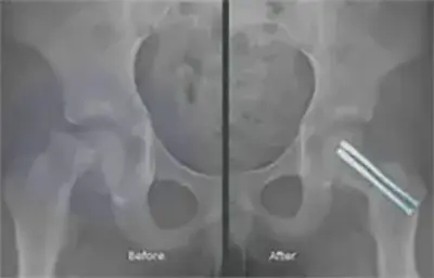 Slipped Capital Femoral Epiphysis - Benjamin Domb MD