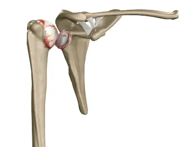Shoulder Anatomy - 3 - Educational Photo