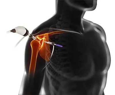 Indications for Shoulder Replacement - Benjamin Domb MD