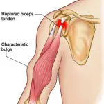 Bicep Tendon Tears and Tendonitis