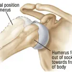 Shoulder Dislocations