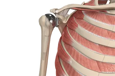 Shoulder Replacement - Benjamin Domb MD