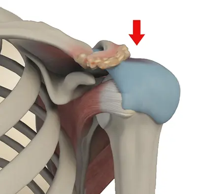 Indications of Shoulder Arthroscopy