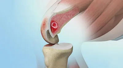 Subchondroplasty - Benjamin Domb MD