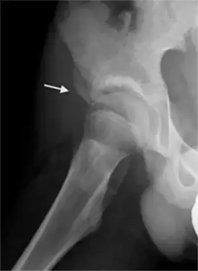 Causes of Subspine Impingement - Benjamin Domb MD
