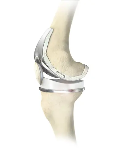Knee Pain - 5 - Educational Photo