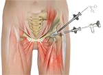 A Promising Future for Patients Undergoing Primary, Revision Hip Arthroscopies