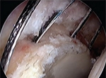 Knotless pull-through Technique Creates Efficiency for Labral Hip Reconstruction